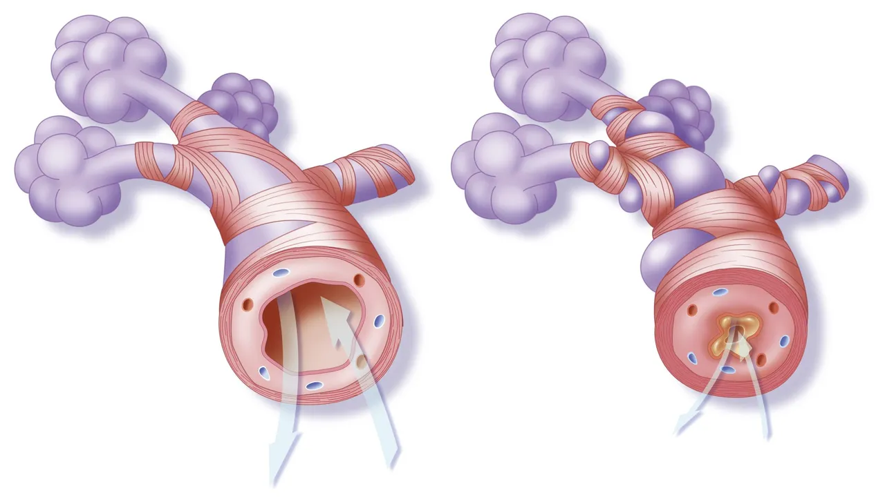 The Connection Between Asthma and Bronchospasm